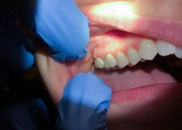Best Broken or Cracked Tooth Emergency Dentist in Santa Clarita, CA